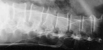 X-Ray of fractured spine